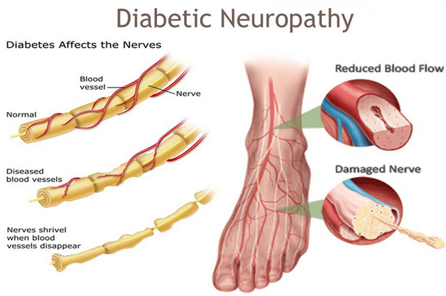 Illustration showing how diabetes affects nerves in the foot. The image compares normal nerves with healthy blood flow to diseased nerves with damaged blood vessels and reduced blood supply, ultimately leading to nerve degeneration. Inset diagrams show a foot with decreased circulation, a narrowed blood vessel, and a damaged nerve.